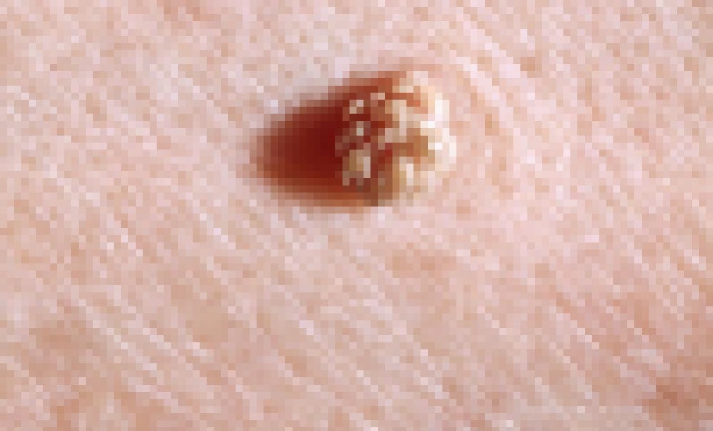 Common wart. (Verruca vulgaris, also known as the common viral wart. The human papillomavirus (HPV) cuases the verruca vulgaris. Warts may develop on any skin surface, but occur most commonly at acral sites. Although war