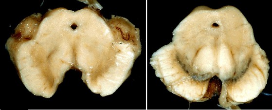 Substantia Nigra di un paziente e di un soggetto sano a confronto