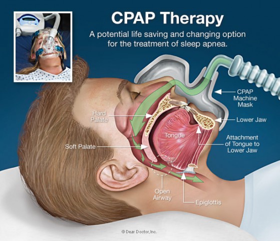 cpap-therapy