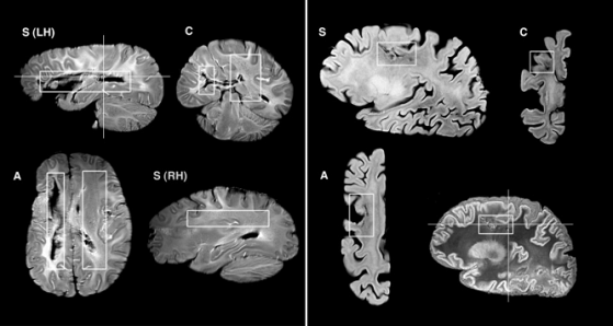 La scansione dei cervelli di Tan e Lelo: l’ emisfero sinistro risulta severamente danneggiato anche nelle sue componenti profonde