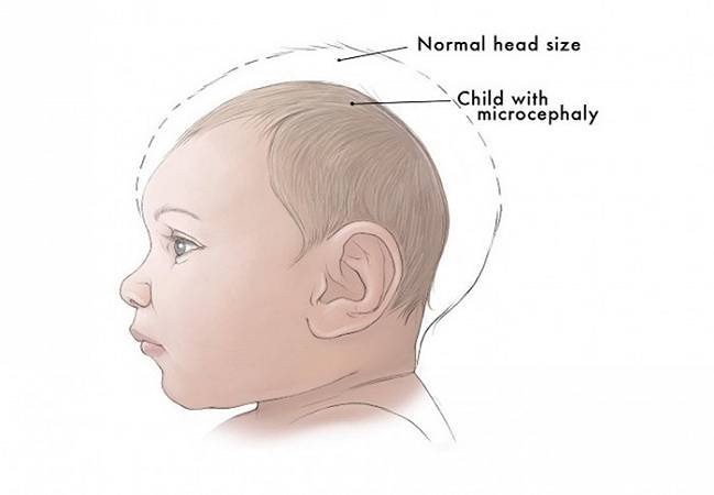 original_microcephaly