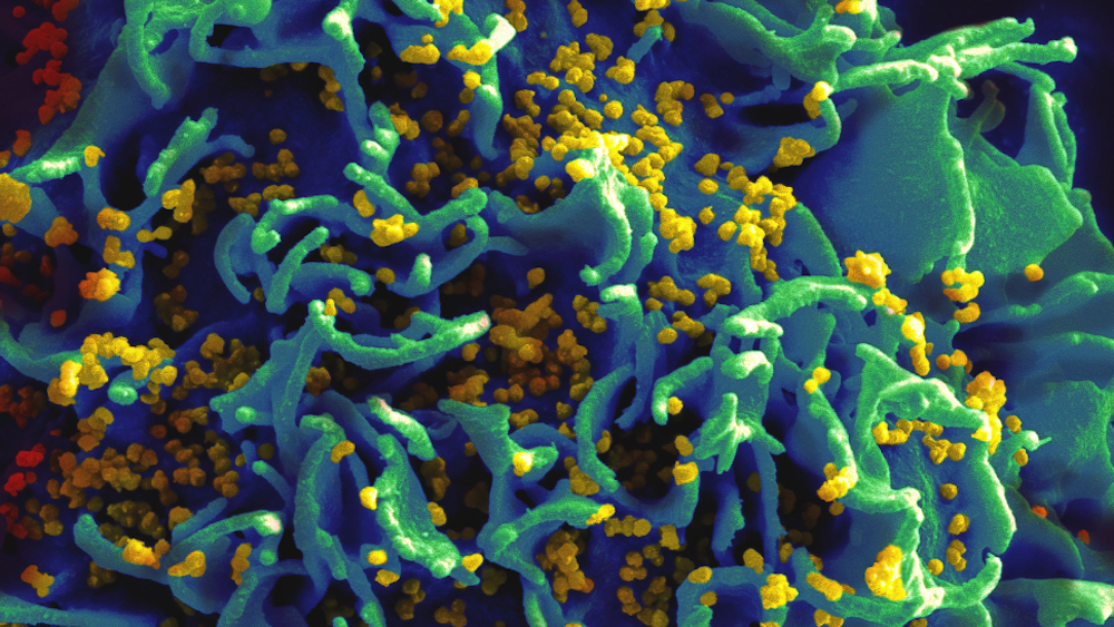 HIV: riuscita la sua eliminazione dalle cellule infette