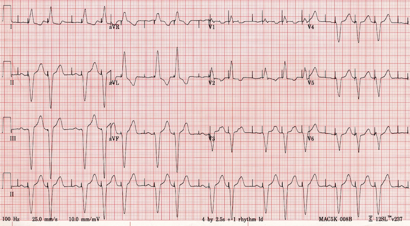 ECG: Come funziona l’elettrocardiogramma
