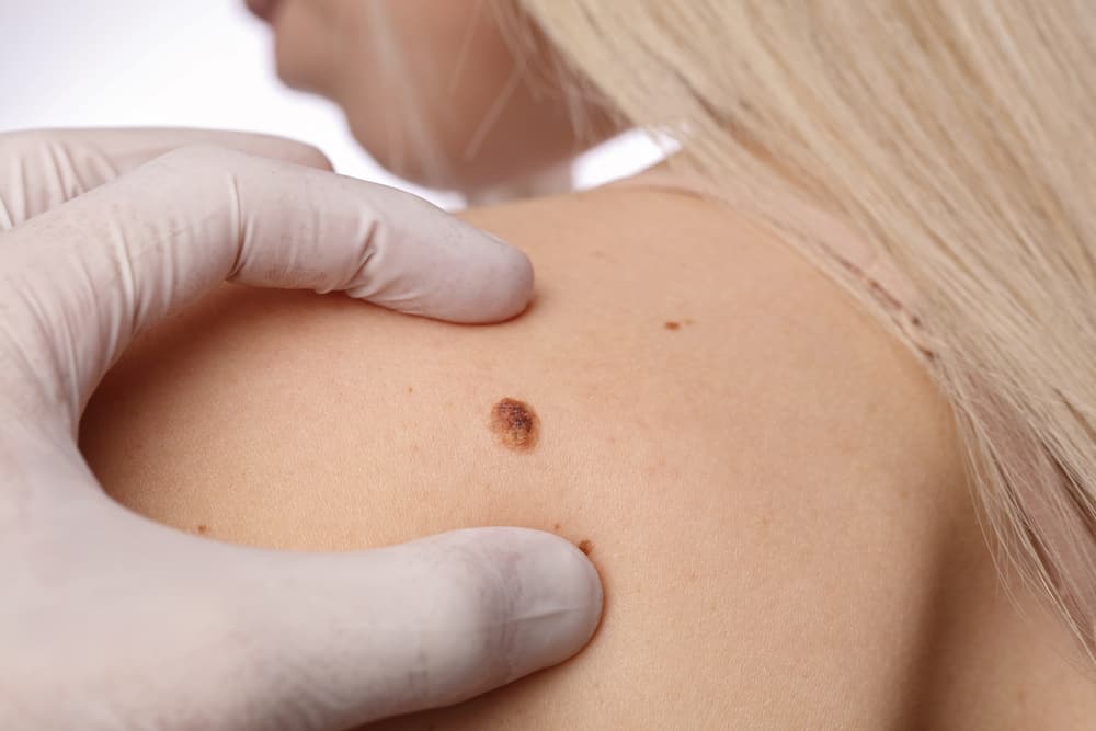 Melanoma: un nuovo cerotto con aghi miniaturizzati per combatterlo