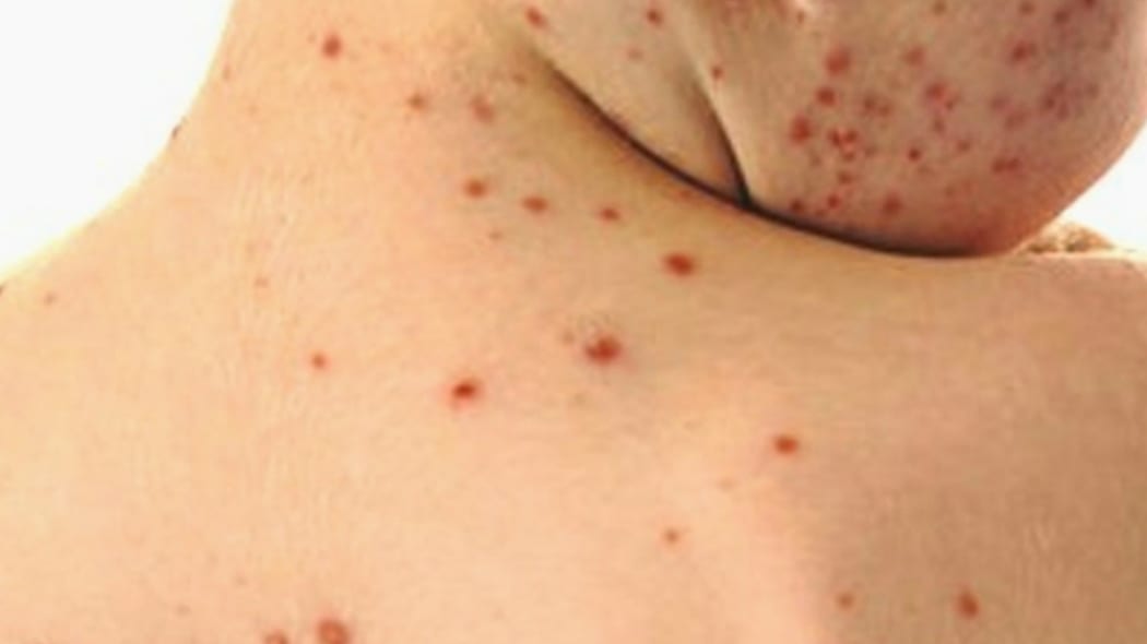 Morbillo e rosolia eliminate da Sri Lanka e Maldive, lo afferma l’OMS