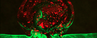 Aneurisma: eccolo ricostruito in bioprinting