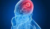 Tumore al cervello nei giovani: nuova terapia