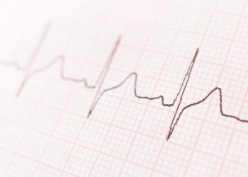 Fibrillazione atriale: nuova tecnologia stabilizza il ritmo del cuore