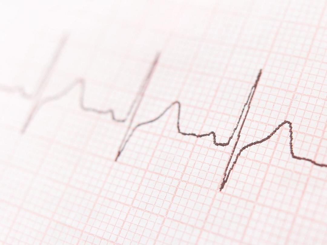 Fibrillazione atriale: nuova tecnologia stabilizza il ritmo del cuore