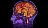 Tumore al cervello: una cura lo rallenta