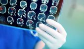 Tumore al cervello: nuova terapia per combatterlo