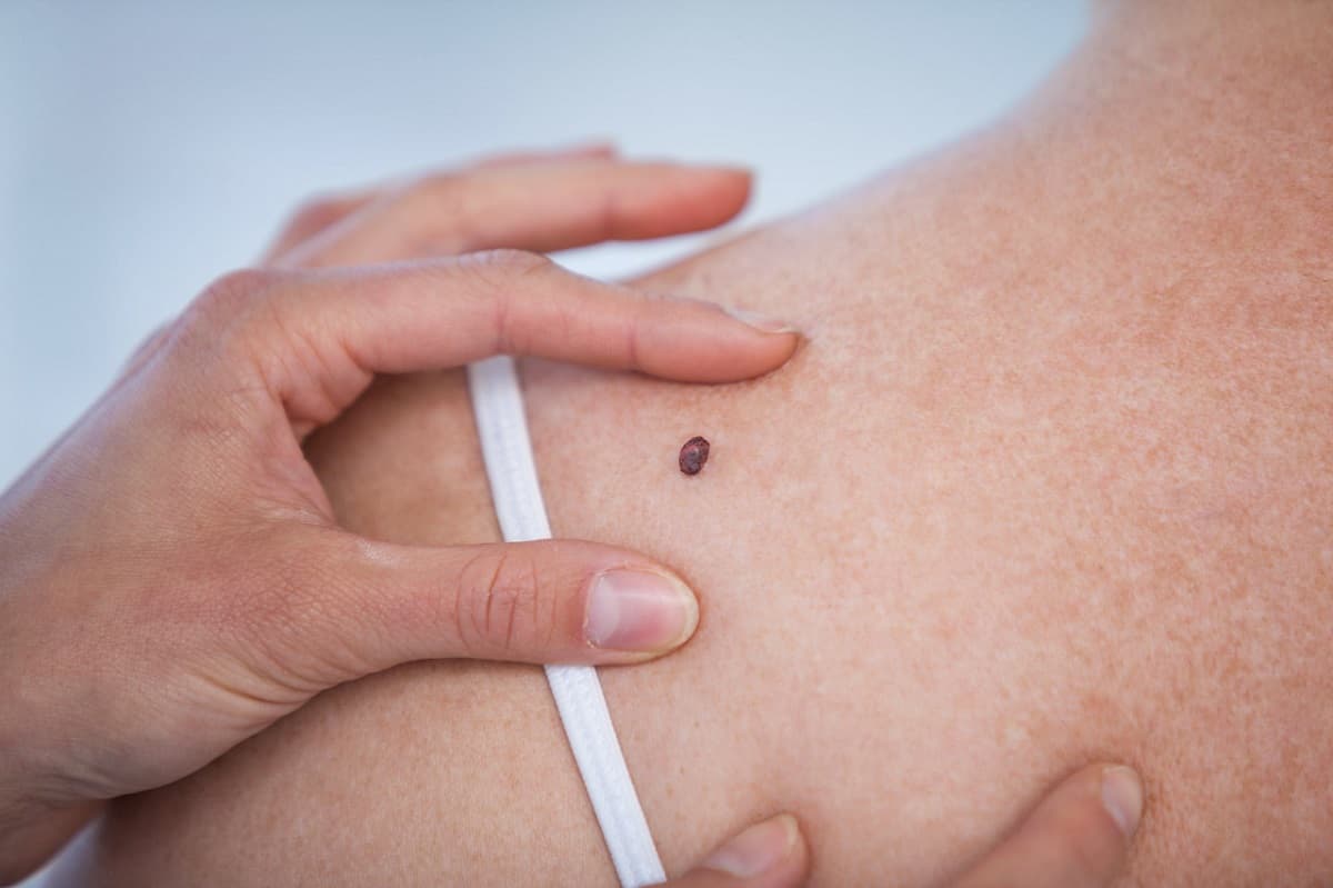 melanoma
