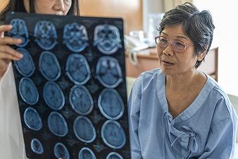 Alzheimer: test del sangue limita i danni neurologici