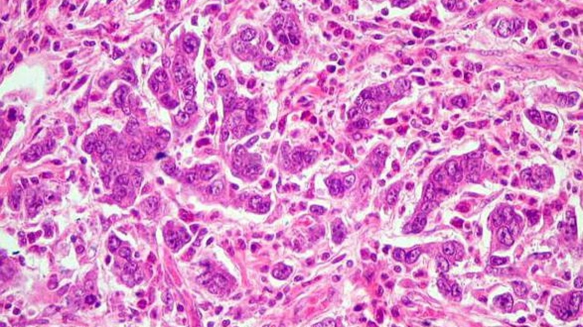 Cancro allo stomaco: cure con due nuove molecole