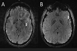 Cervello: ecco com’è quello di chi soffre di emicrania