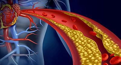 Colesterolo “buono”, a rischio la sua capacità di predizione di malattia cardiache