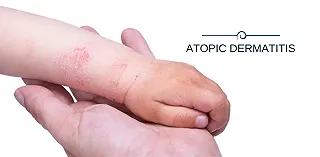 Dermatite atopica, nuovo farmaco mostra risultati a lungo termine