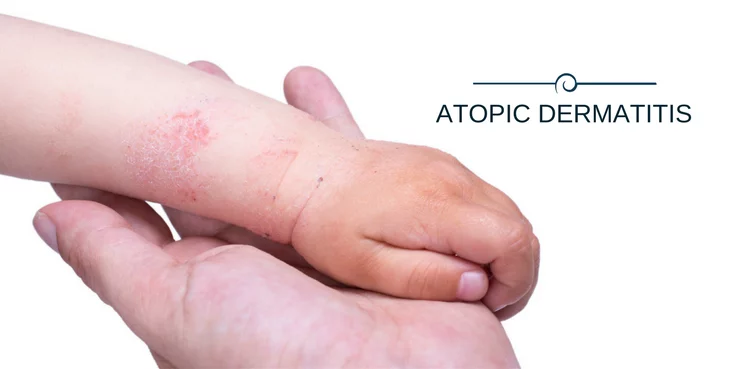 Dermatite atopica, nuovo farmaco mostra risultati a lungo termine