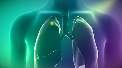 Cancro ai polmoni, il nuovo farmaco lo illumina per identificarlo meglio
