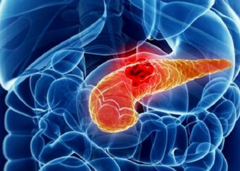 Cancro al pancreas: la chemio prima dell'intervento migliora i tassi di sopravvivenza