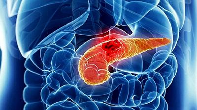Cancro al pancreas: la chemio prima dell’intervento migliora i tassi di sopravvivenza