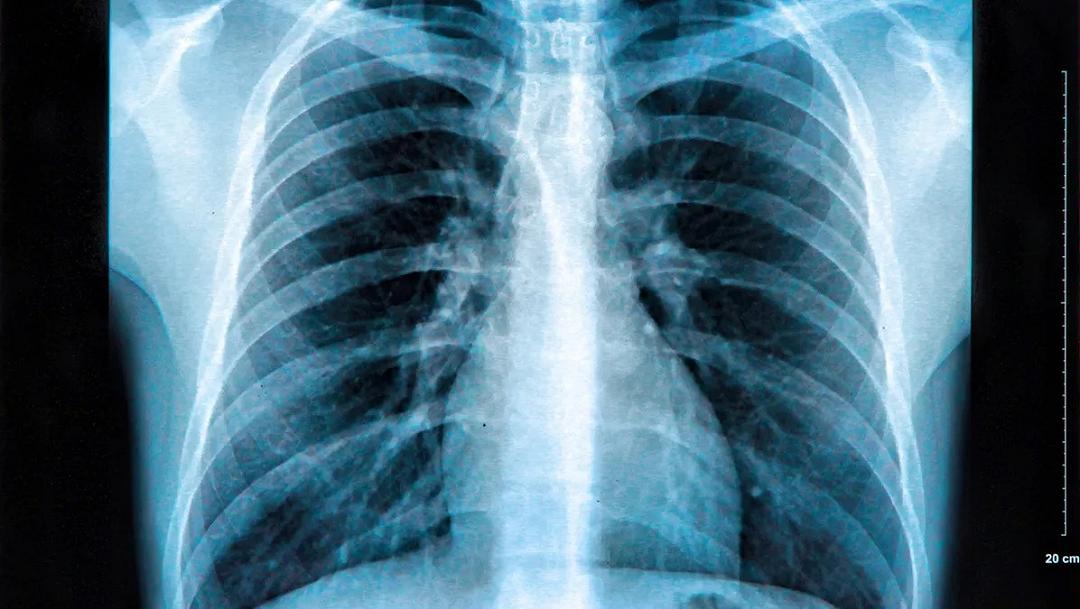 Infarto e ictus: intelligenza artificiale e radiografia li prevedono