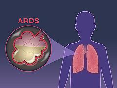 I ricercatori identificano una cura contro la sindrome da distress respiratorio