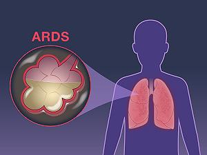 I ricercatori identificano una cura contro la sindrome da distress respiratorio
