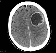 Apprendimento automatico per prevedere la progressione del tumore cerebrale