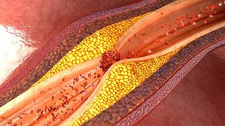 Granulomatosi di Wegener: i sintomi