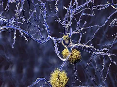 La FDA approva il farmaco per l’Alzheimer lecanemab