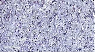 Sarcoma, individuato il gene responsabile