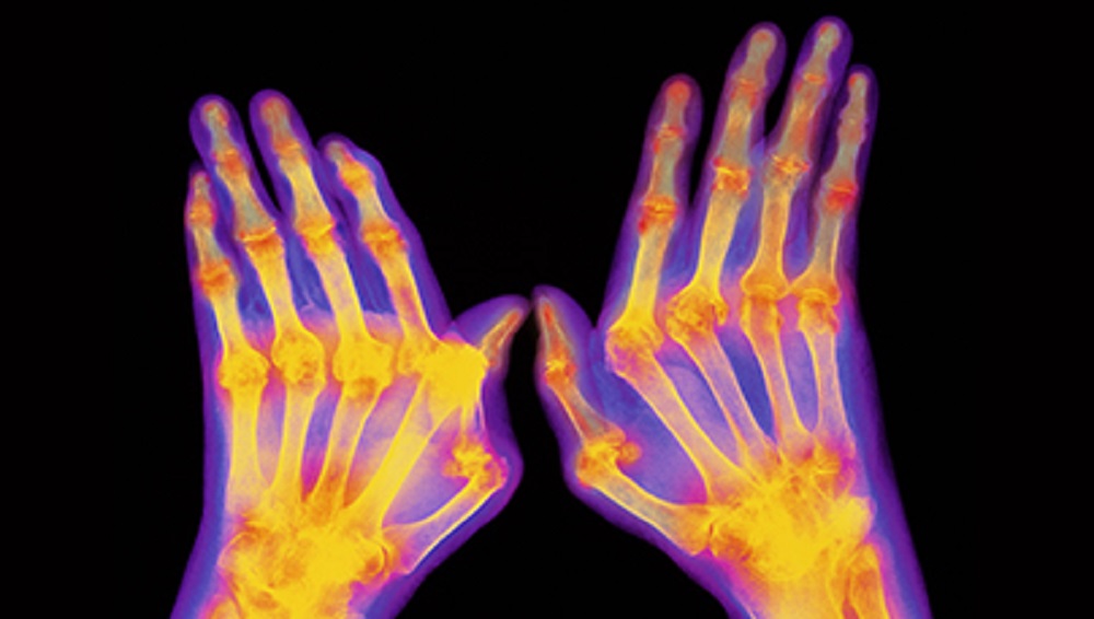 Artrosi della mano, sviluppato un nuovo farmaco