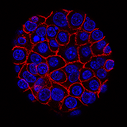 Come il cancro al pancreas sfida le cure