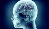 Tumori al cervello: la chirurgia aiuta quelli di basso grado