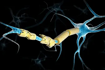 Una nuova scoperta sulla sclerosi multipla