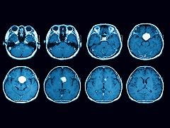 Perfezionato il biomarcatore che predice la recidiva nel meningioma