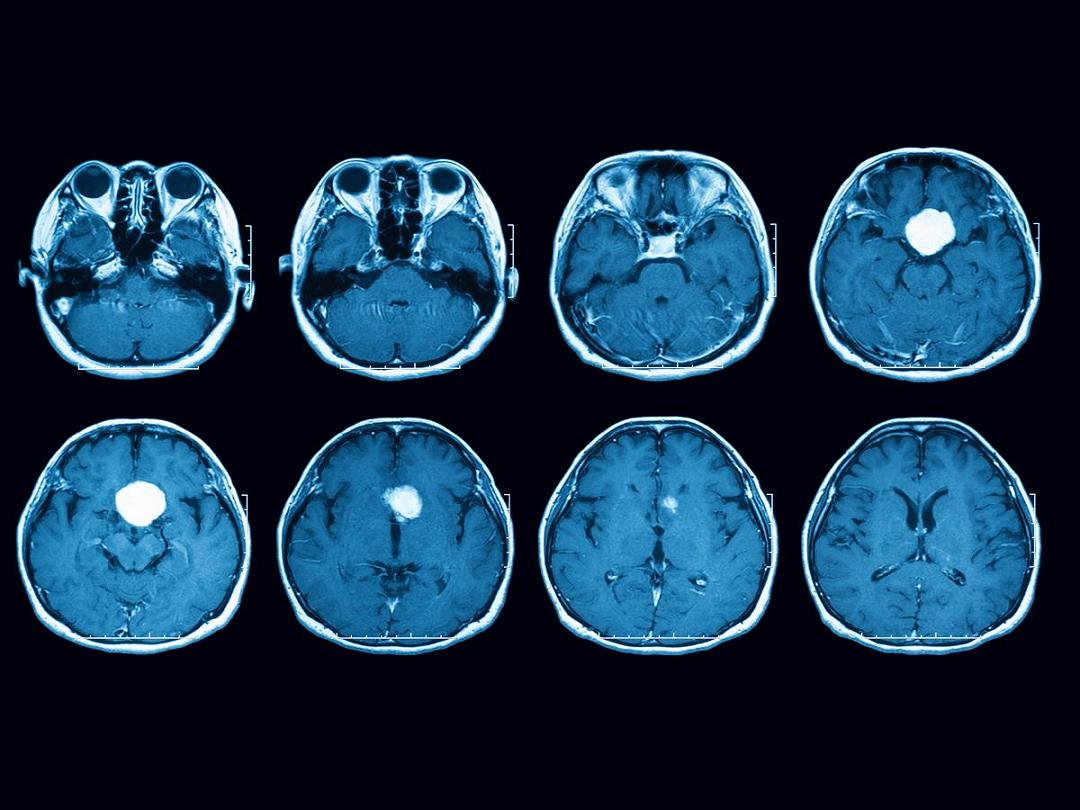 Perfezionato il biomarcatore che predice la recidiva nel meningioma