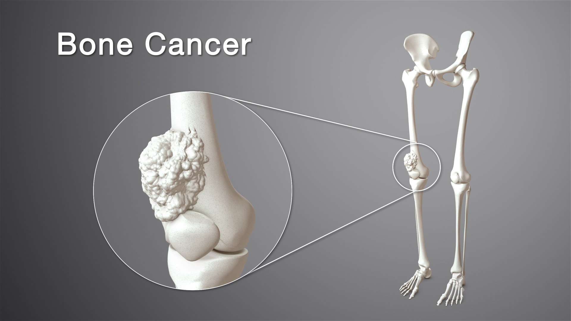 Spp24: una promettente soluzione per il trattamento dell’osteosarcoma