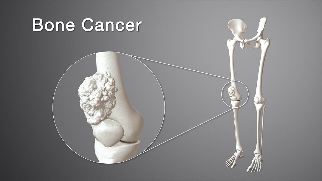 Spp24: una promettente soluzione per il trattamento dell’osteosarcoma