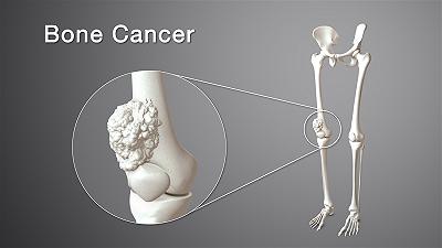 Spp24: una promettente soluzione per il trattamento dell’osteosarcoma