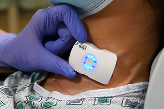 FloPatch: la tecnologia a ultrasuoni avanzata per la gestione della sepsi