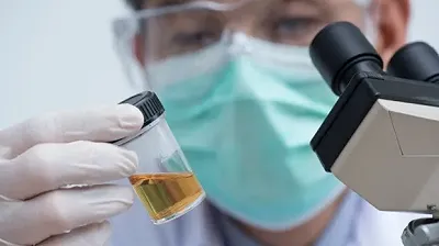 Test genetico delle urine predice il cancro alla vescica anni prima della diagnosi