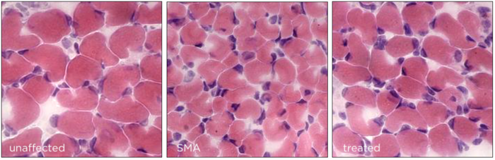 Importante scoperta nella ricerca sulla cura dell’Atrofia Muscolare Spinale