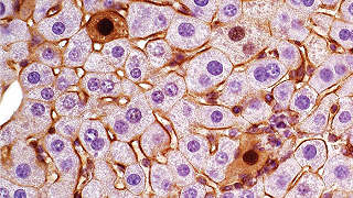 Identificare le molteplici identità dei geni del cancro