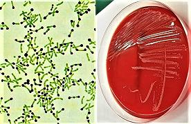 Epidemia di difterite – aggiornamenti dall’Europa, Regno Unito, Germania, Austria