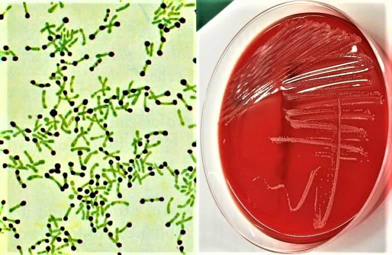 Epidemia di difterite – aggiornamenti dall’Europa, Regno Unito, Germania, Austria