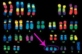 Sindrome di Down: dimostrate per la prima volta le basi genetiche dei cambiamenti facciali