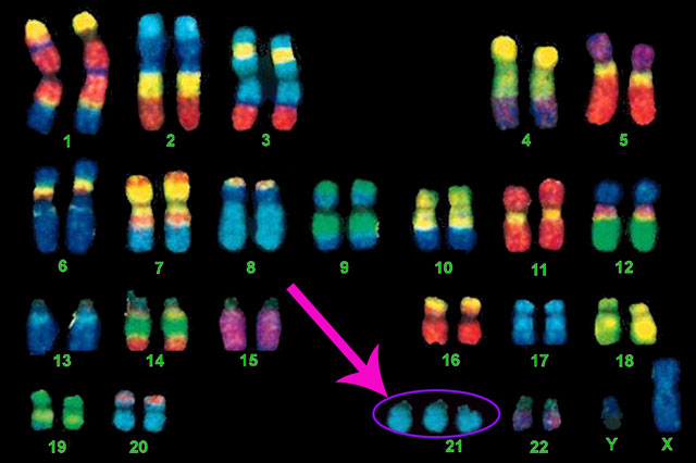 Sindrome di Down: dimostrate per la prima volta le basi genetiche dei cambiamenti facciali