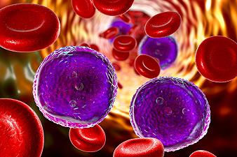 Leucemia mieloide acuta: creati linfociti Car-Cik